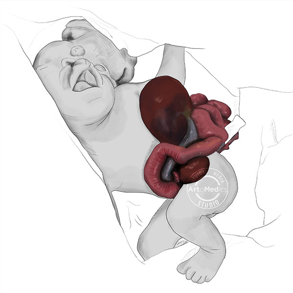 Gastroschisis