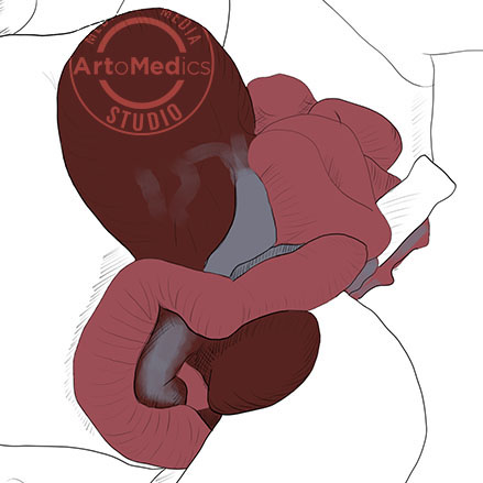 Gastroschisis illustration