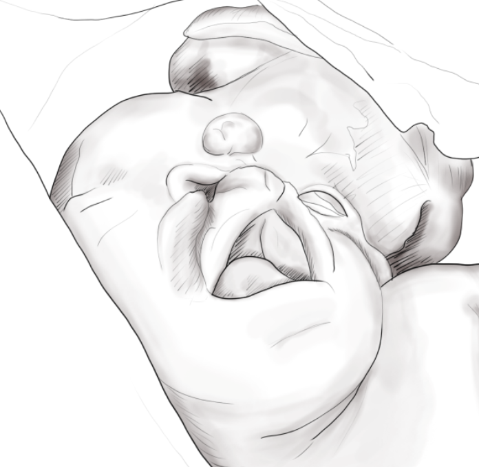 Medical illustration of baby with exencephaly and cleft palate